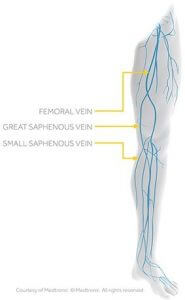 Vein Treatment Skypoint Medical