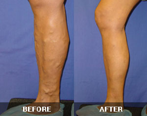 Vein Therapy Skypoint Medical