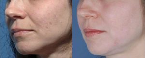Acne Scarring Schaumburg Skypoint Medical